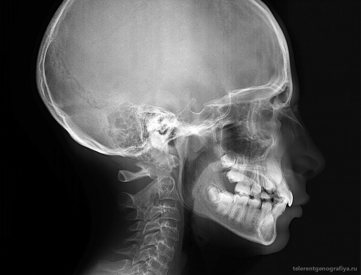 Детский череп рентген. Детский череп рентген снимок. Снимок черепа новорождённого. Рентгенограмма черепа новорожденного.